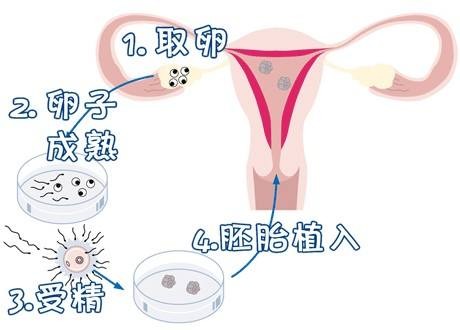 人工孕妈供卵服务怎么预约